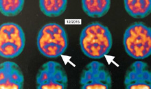 HBOT a montré une amélioration dans la maladie d'alzheimer